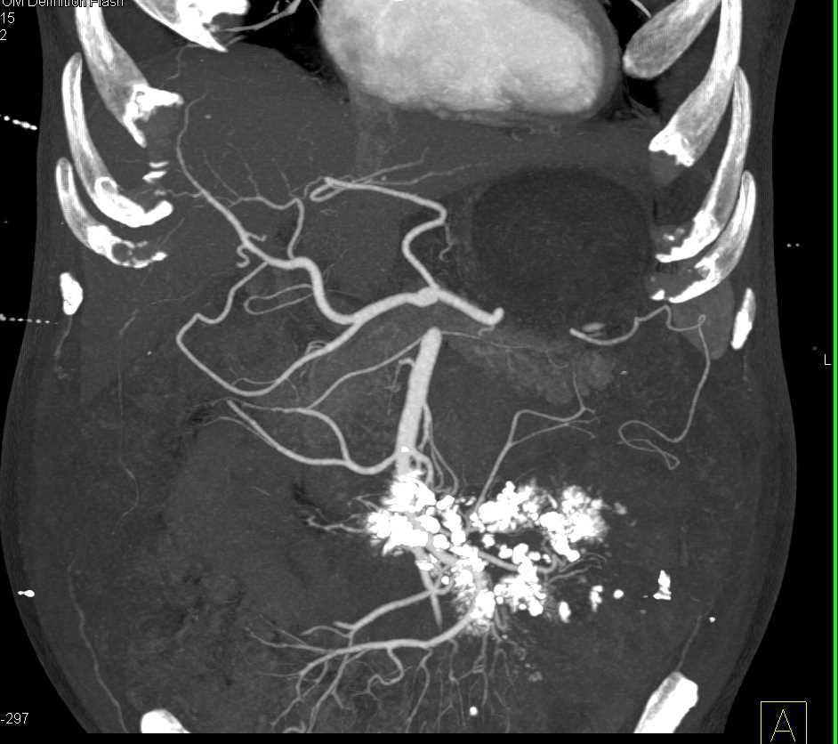 Sclerosing Mesenteritis with Cavernous Transformation of the Portal Vein - CTisus CT Scan