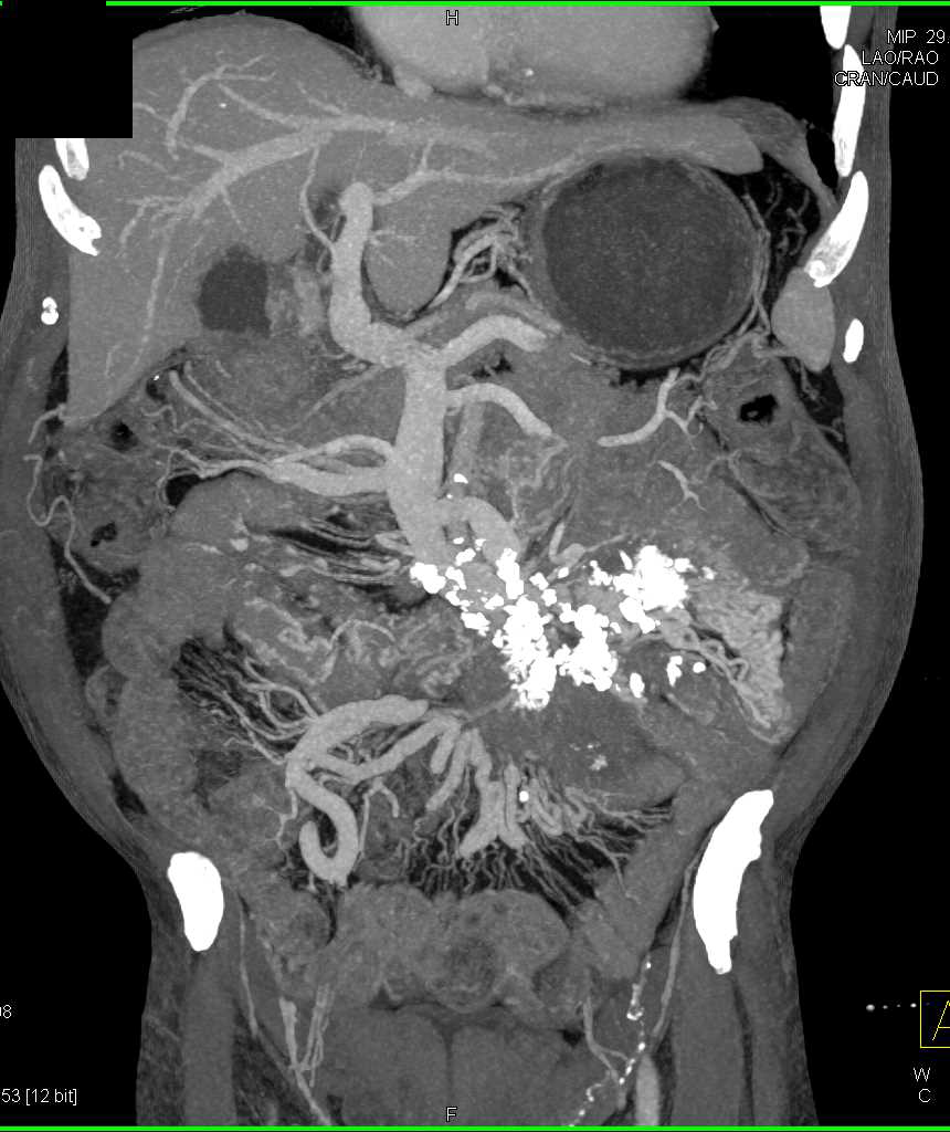 Sclerosing Mesenteritis with Cavernous Transformation of the Portal Vein - CTisus CT Scan