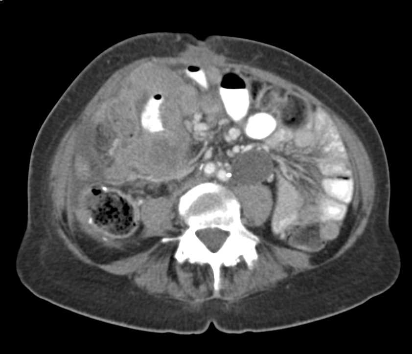 Small Bowel Lymphoma - CTisus CT Scan