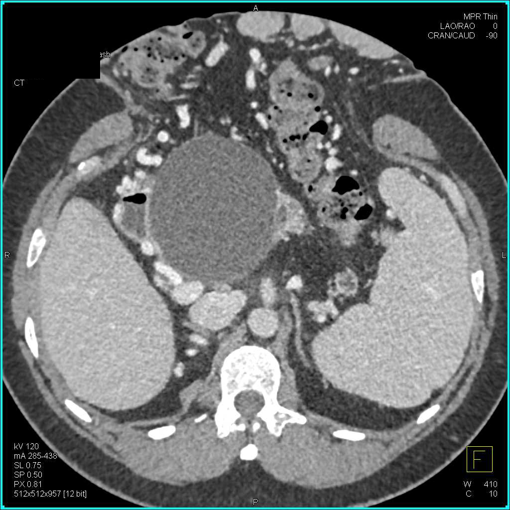 Camera is Obstructed in Small Bowel due to Adhesions - CTisus CT Scan