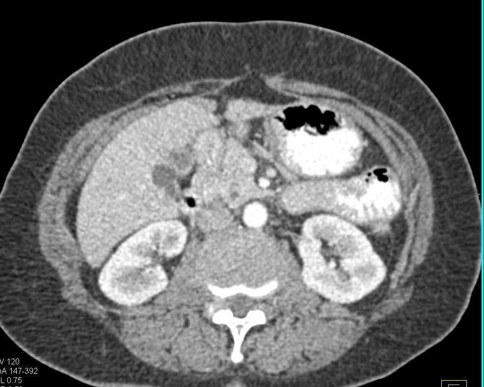 Graft vs Host Disease - CTisus CT Scan