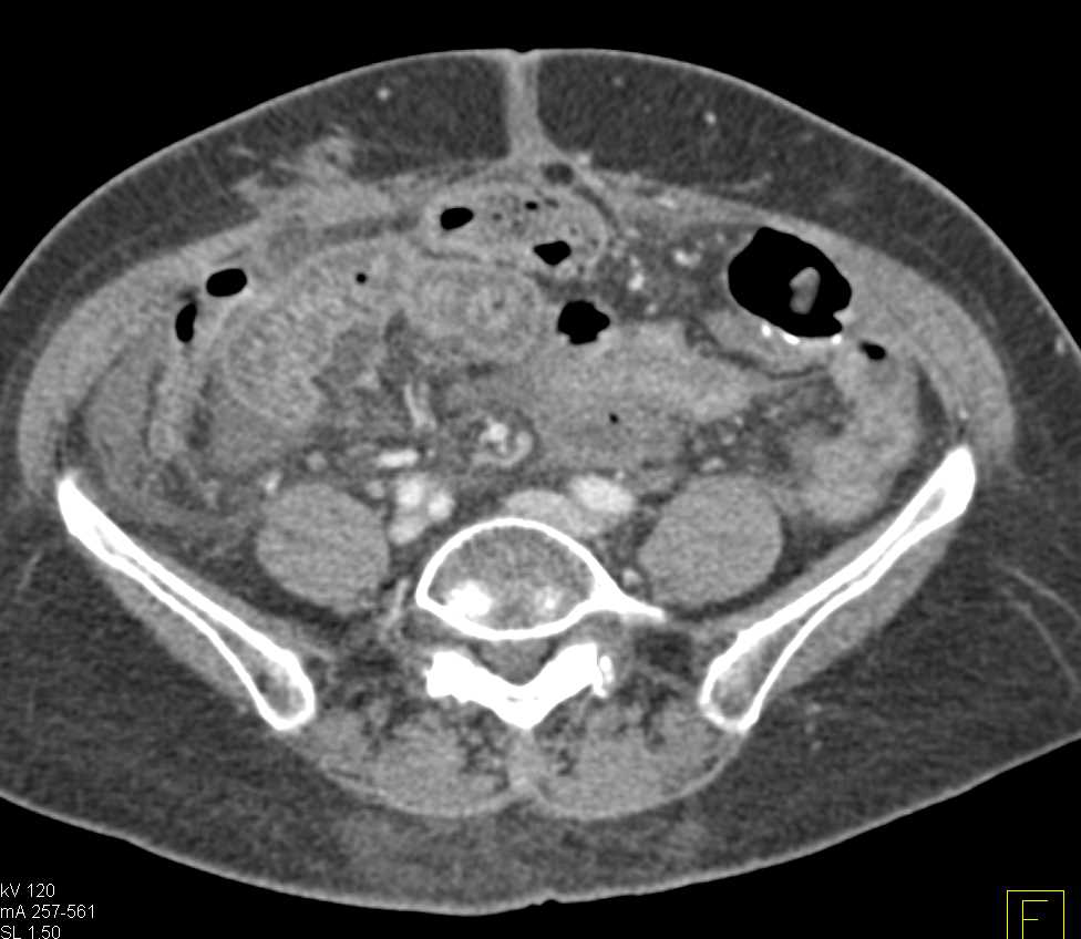 Graft vs Host Disease - CTisus CT Scan