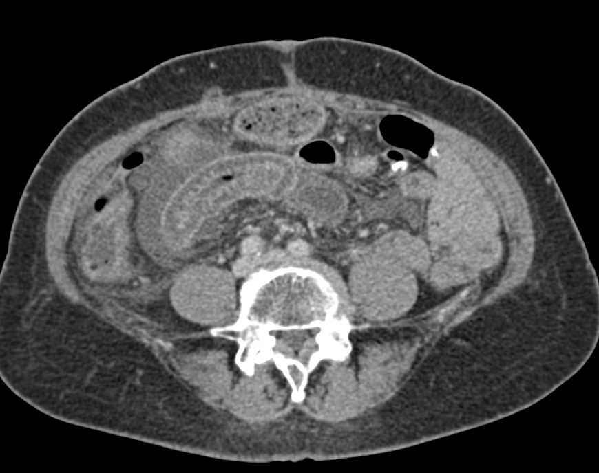 Graft vs Host Disease - CTisus CT Scan