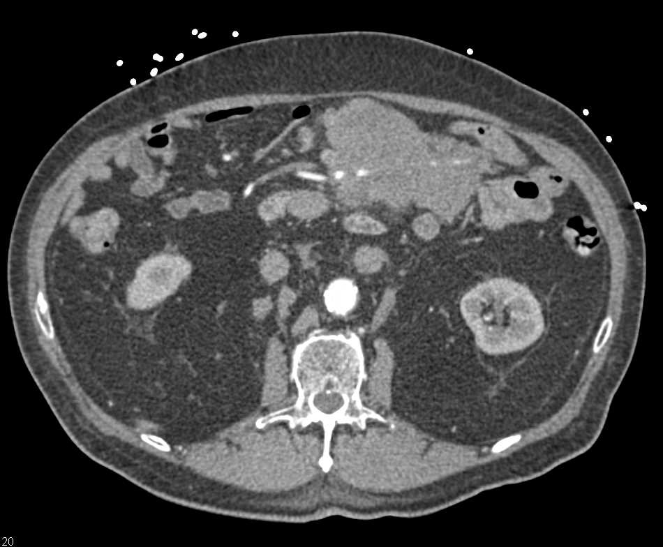 Lymphoma Mesentery with Vascular Encasement - CTisus CT Scan