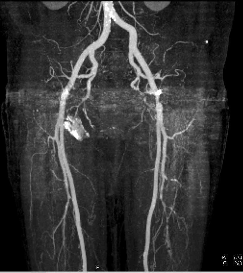 Duodenal Adenocarcinoma Looks Similar to a Ampullary Carcinoma - CTisus CT Scan