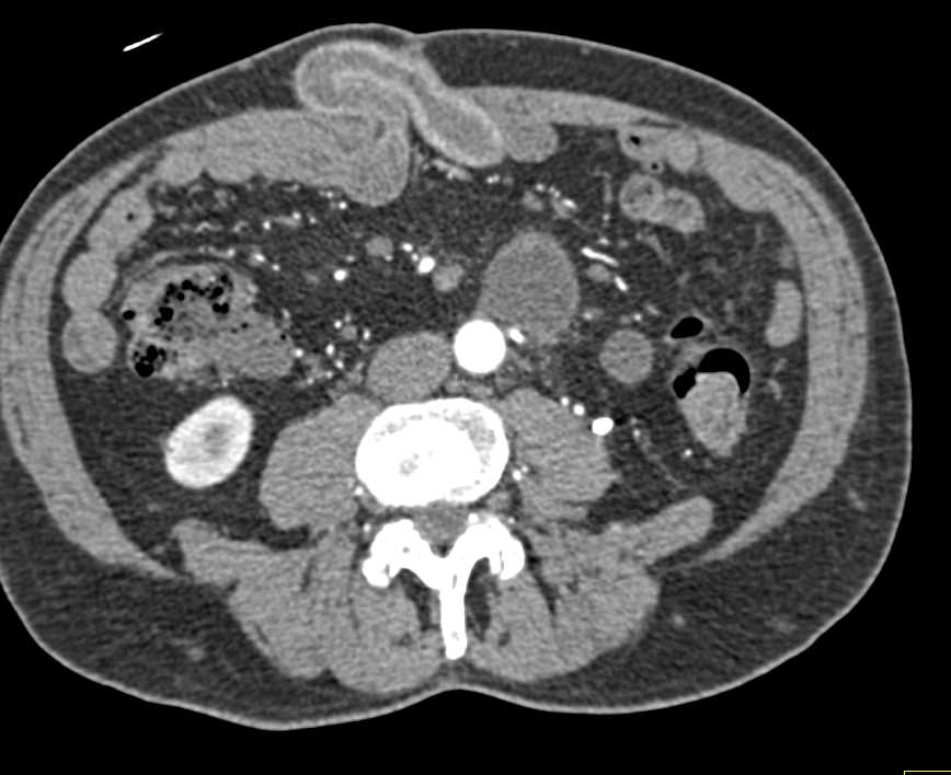 Small Bowel Obstruction (SBO) with Midline Ventral Hernia - CTisus CT Scan