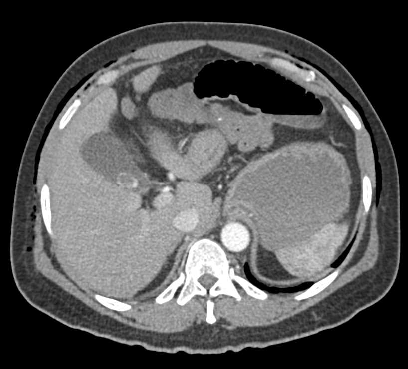 Small Bowel Obstruction (SBO) in a Post Operative Patient - CTisus CT Scan