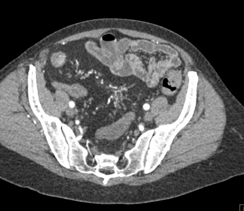 Crohn's Disease with Multiple Strictures and Comb Sign - CTisus CT Scan