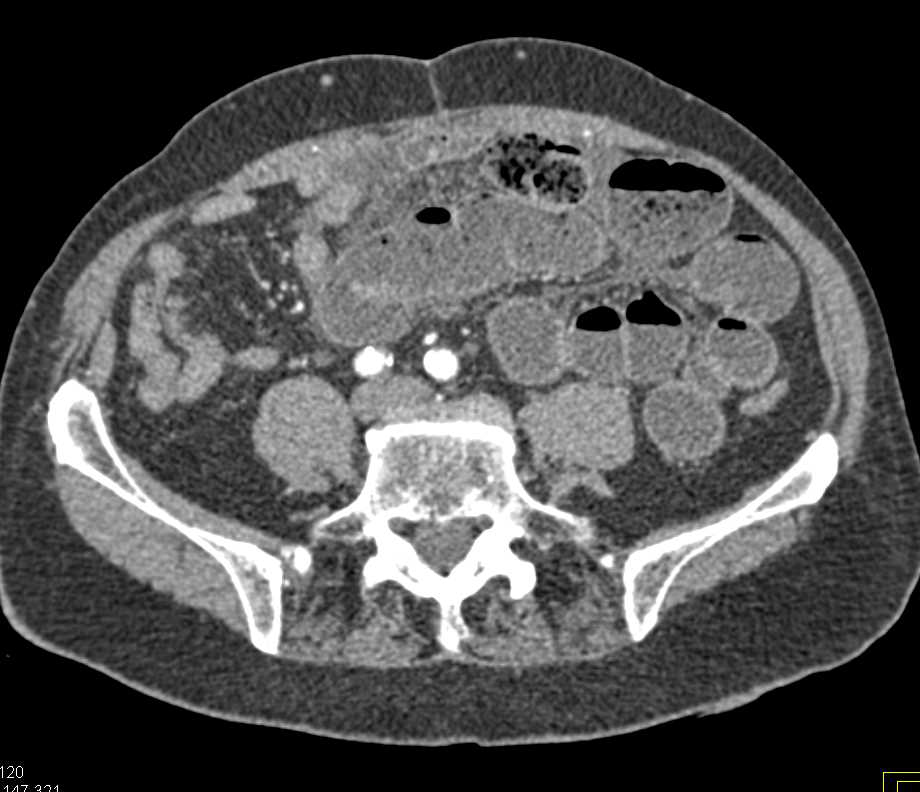 Ischemic Small Bowel with Misty Mesentery and Decreased Bowel Enhancement - CTisus CT Scan