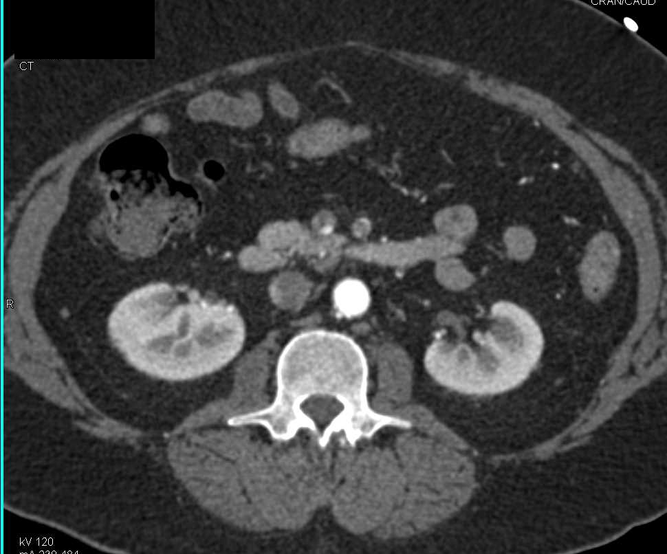 Superior Mesenteric Artery (SMA) Occlusion with Ischemic Bowel and Midgut Volvulus - CTisus CT Scan