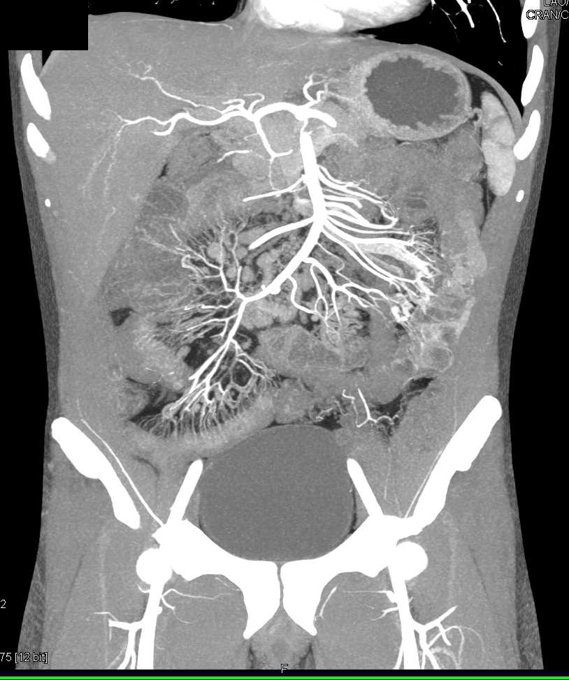 Ulcerative Colitis Right Colon with Nodes and Comb Sign - CTisus CT Scan