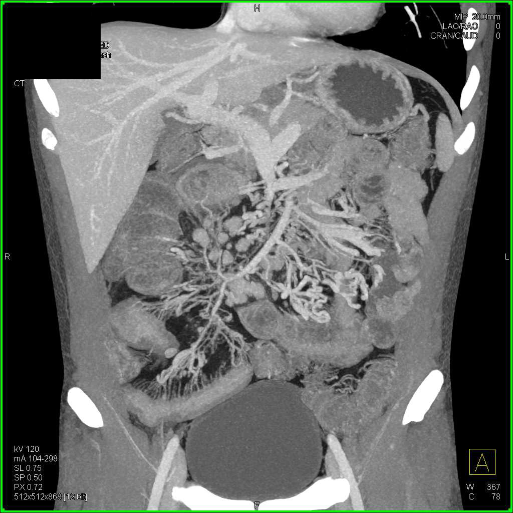 Crohn's Disease Right Colon with Nodes and Comb Sign - CTisus CT Scan