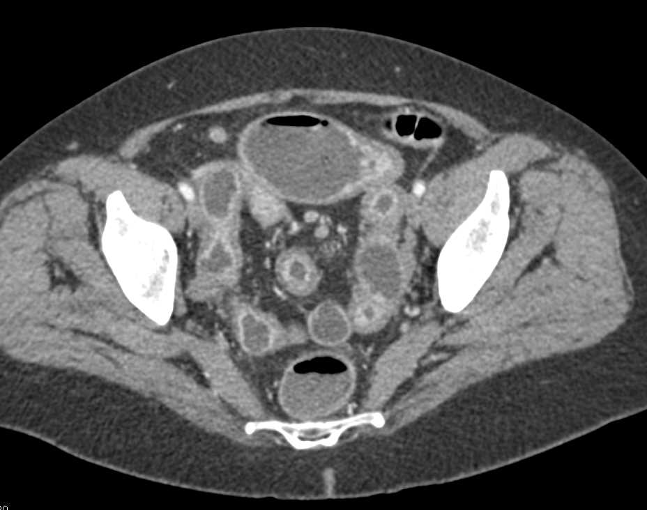 Crohn's Disease with Inflamed Small Bowel Loops - CTisus CT Scan