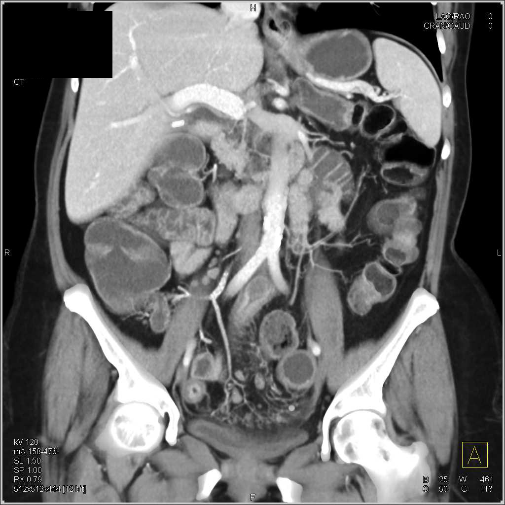 Crohn's Disease with Inflamed Small Bowel Loops - CTisus CT Scan