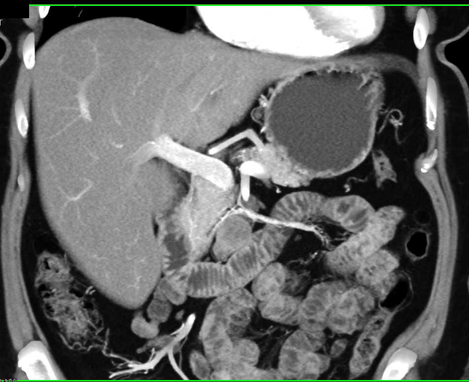 Carcinoid Tumor Located Near the Uncinate Process - CTisus CT Scan