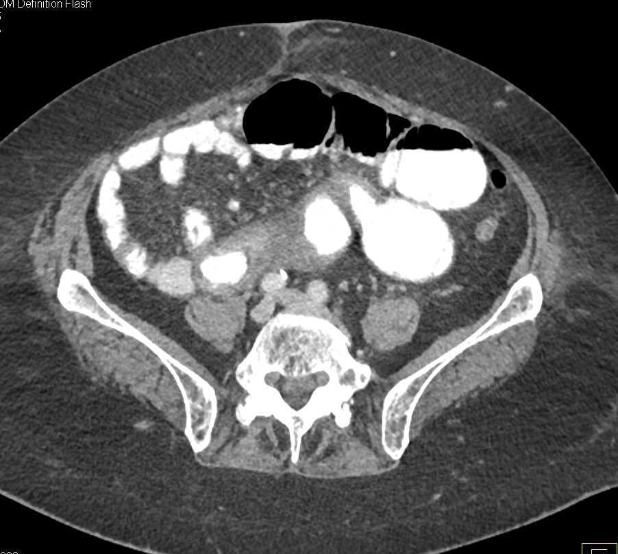 Small Bowel Obstruction due to Crohn's Disease - CTisus CT Scan