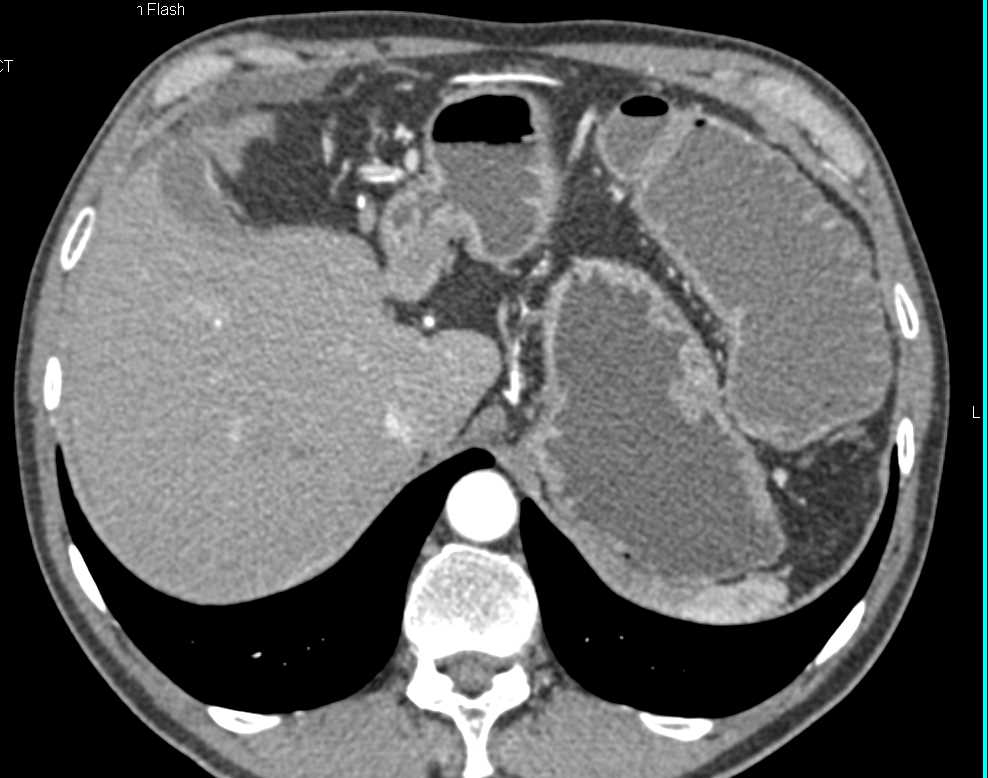 Small Bowel Obstruction (SBO) with Ascites - CTisus CT Scan