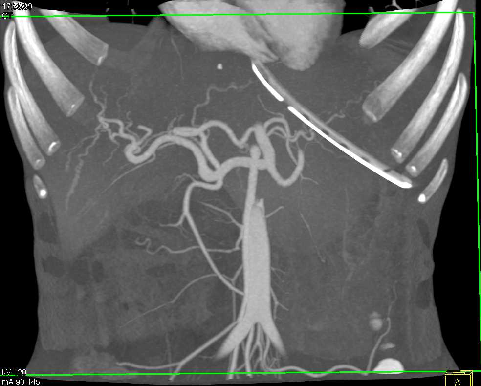 Large Cyst Compressing the Duodenum - CTisus CT Scan