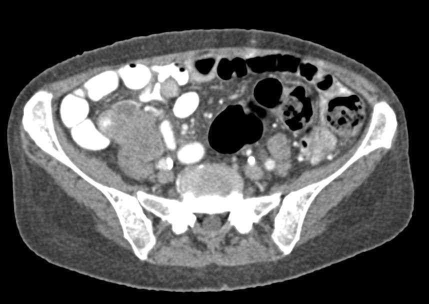 Lymphoma Involves the Terminal Ileum - CTisus CT Scan