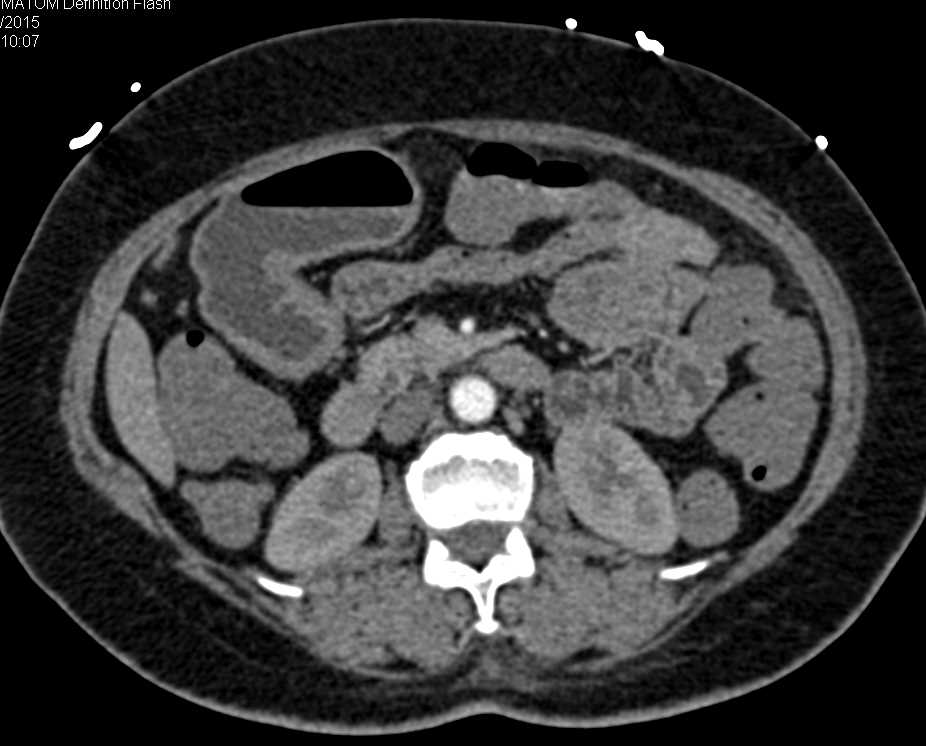 Subtle 3cm GIST Tumor in Proximal Jejunum - CTisus CT Scan