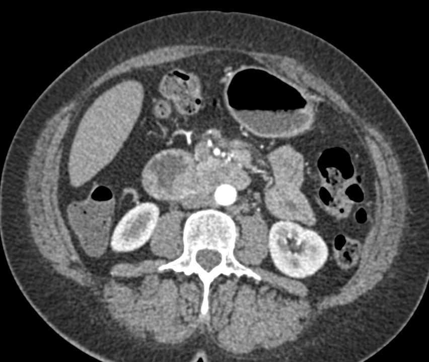 Adenocarcinoma of the 4th Portion of the Duodenum - CTisus CT Scan