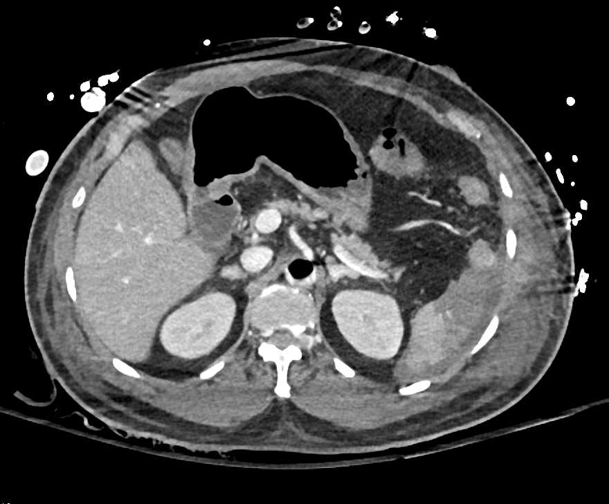 Ischemic Bowel with Pneumatosis, Ascites and Splenic Infarcts in Patient With a Intra-arterial Balloon Pump - CTisus CT Scan
