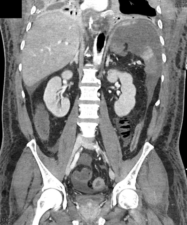 Ischemic Bowel with Pneumatosis, Ascites and Splenic Infarcts in Patient With a Intra-arterial Balloon Pump - CTisus CT Scan