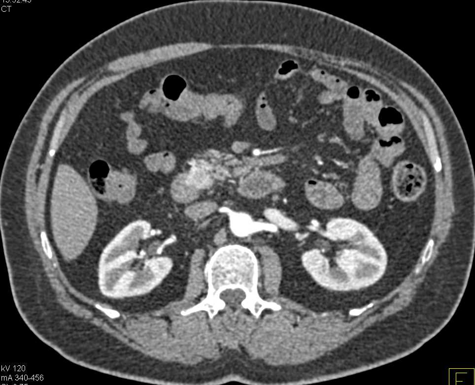 Vascular GIST Tumor Duodenum Simulates a Neuroendocrine Tumor of the Pancreas - CTisus CT Scan