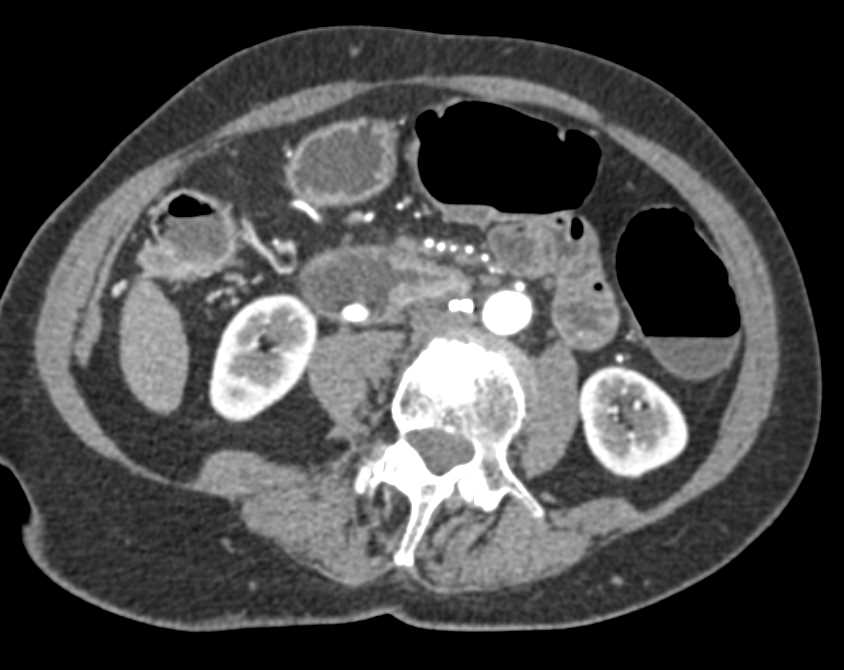 Duodenal Carcinoma Involves the Ampulla - CTisus CT Scan