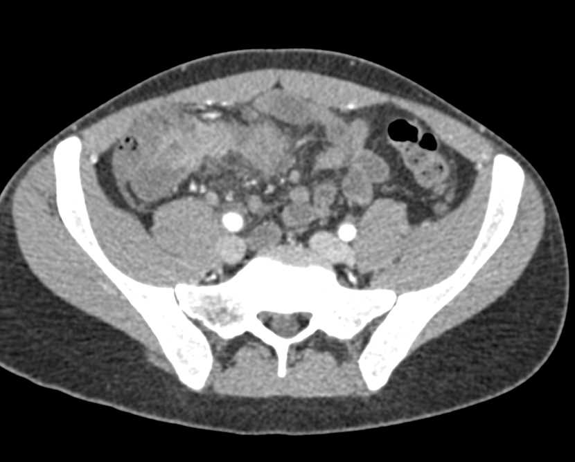 Crohn's Disease with Inflamed Distal Ileum - CTisus CT Scan