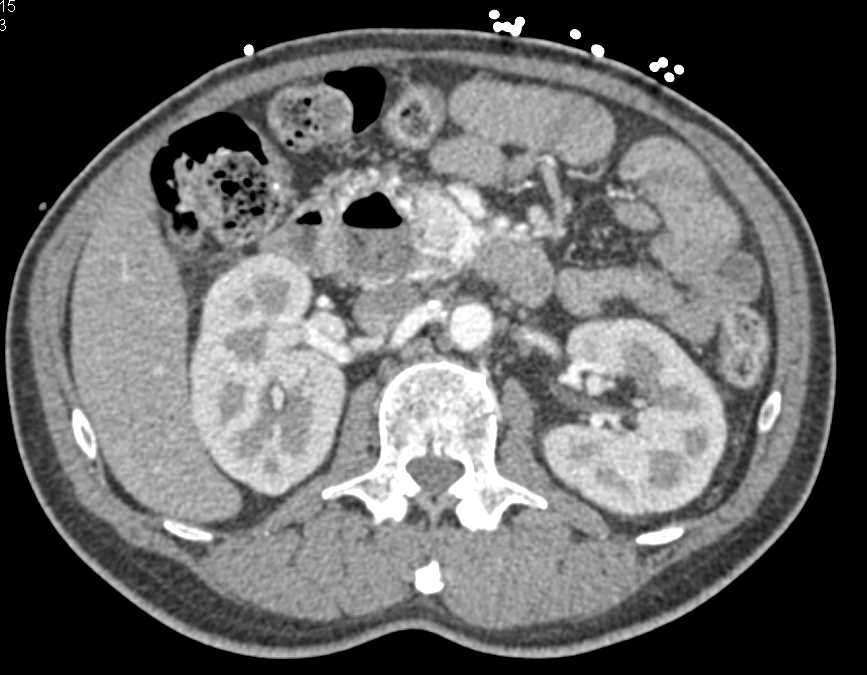 Duodenal Diverticulum Simulates a Pancreatic Mass - CTisus CT Scan