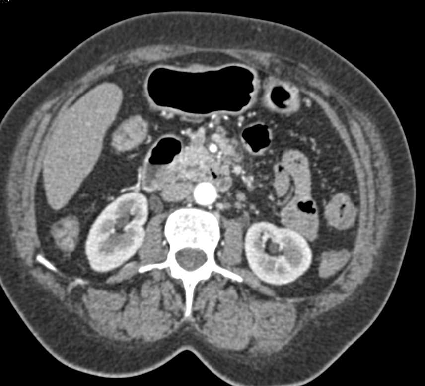 Carcinoid Tumor Near Root of Mesentery - CTisus CT Scan