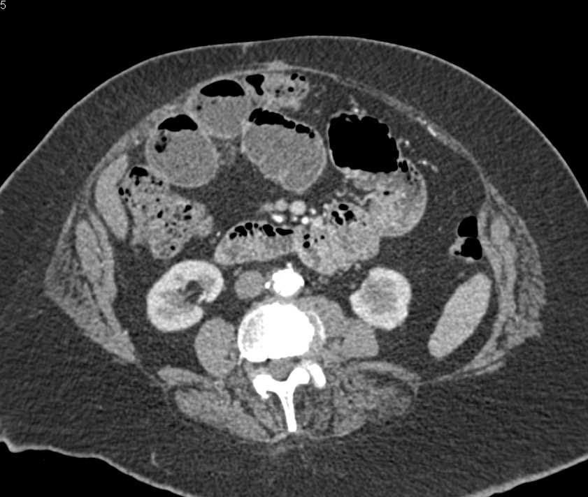 Small Bowel Obstruction (SBO) with Ischemic Bowel due to Incarcerated Hernia - CTisus CT Scan