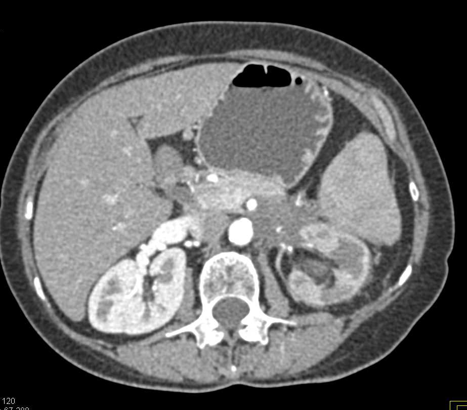 Pancreatic Cancer Invades Duodenum and Left Kidney. Stent in Duodenum - CTisus CT Scan