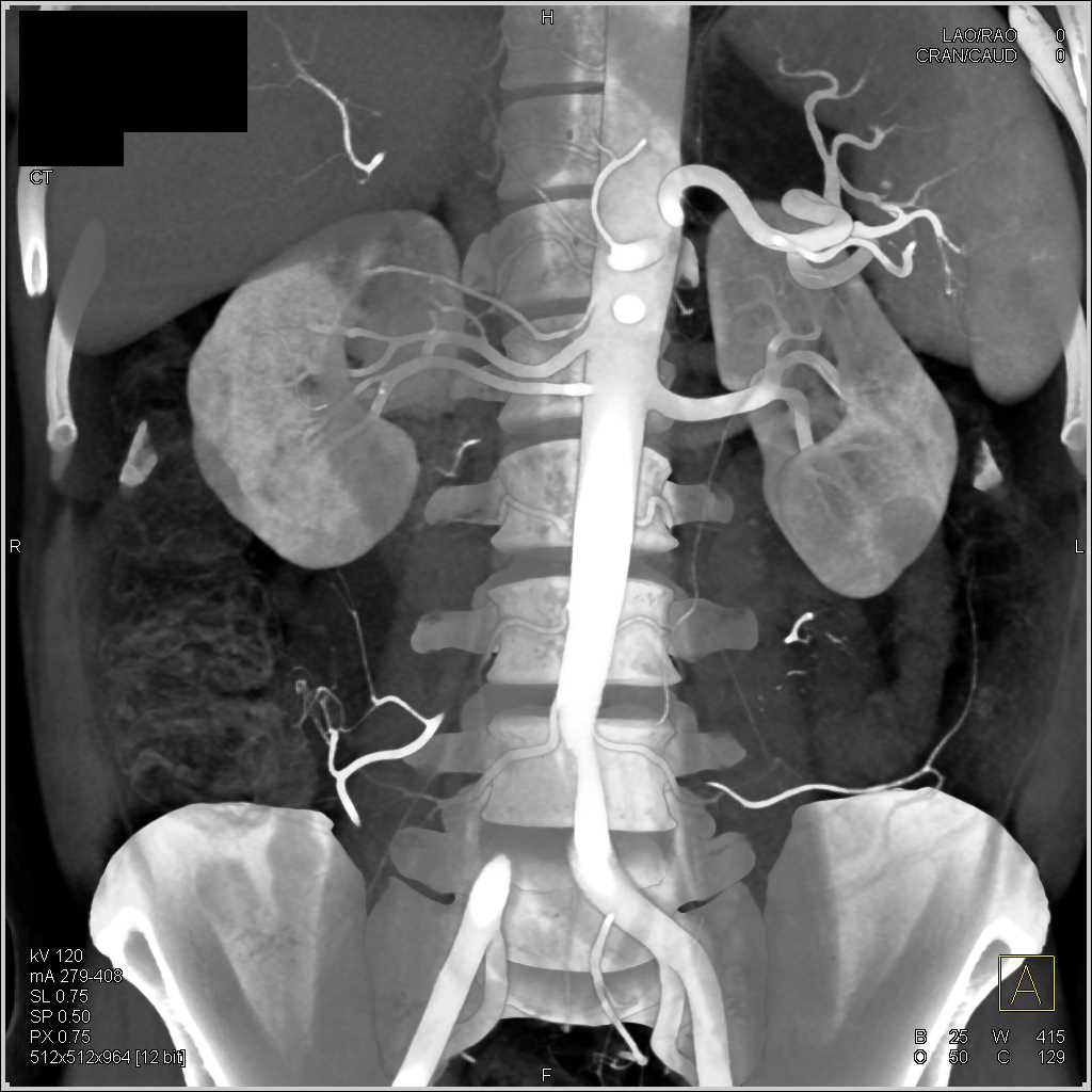 Carcinoid Tumor in the Root of the Mesentery Encases Superior Mesenteric Artery (SMA) and Superior Mesenteric Vein (SMV) - CTisus CT Scan