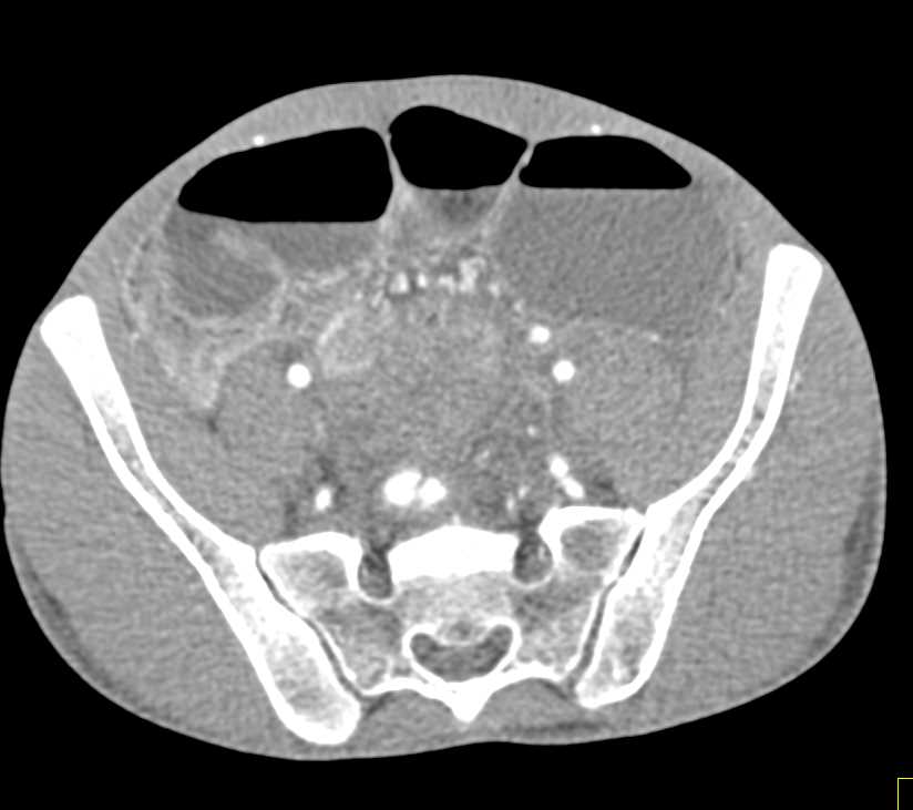 Small Bowel Obstruction (SBO) with Midgut Volvulus - CTisus CT Scan