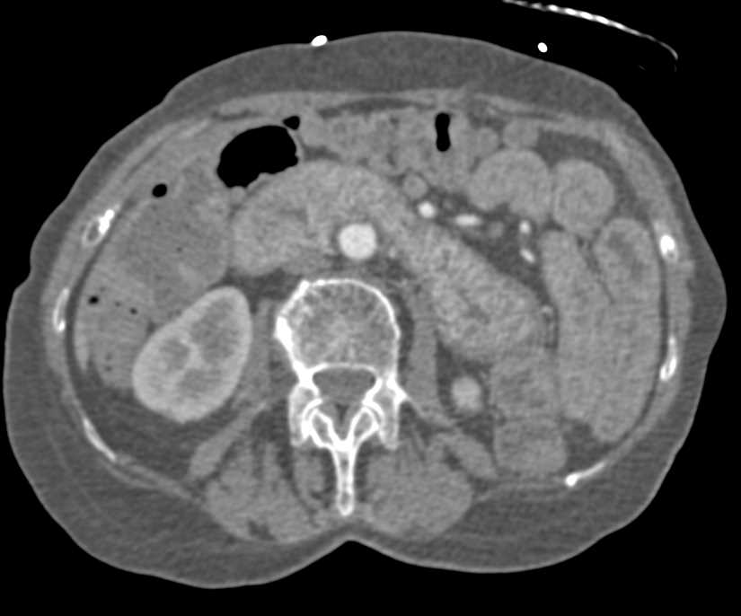 Thickening of Small Bowel with Sprue - CTisus CT Scan