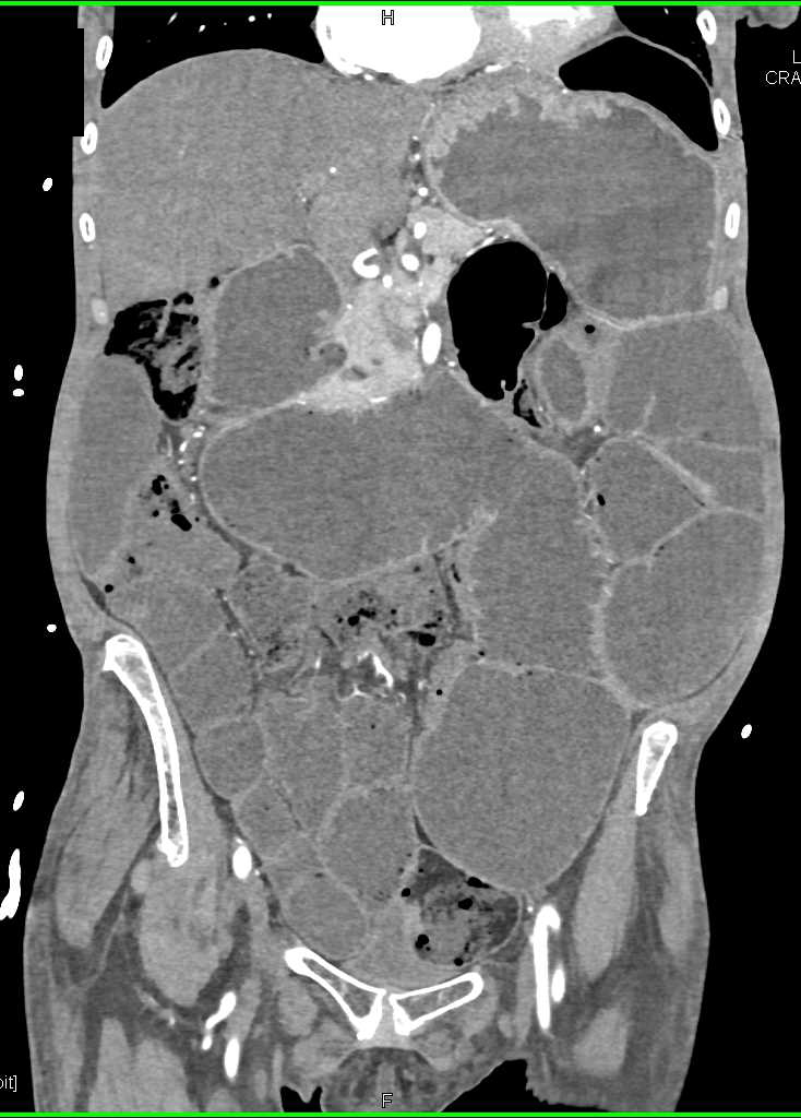 Small Bowel Obstruction (SBO) with Adhesions - CTisus CT Scan