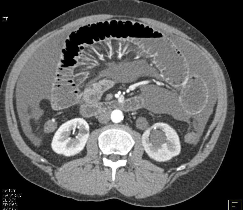 Small Bowel Obstruction (SBO) with Ischemic Bowel and Midline Incarcerated Hernia - CTisus CT Scan