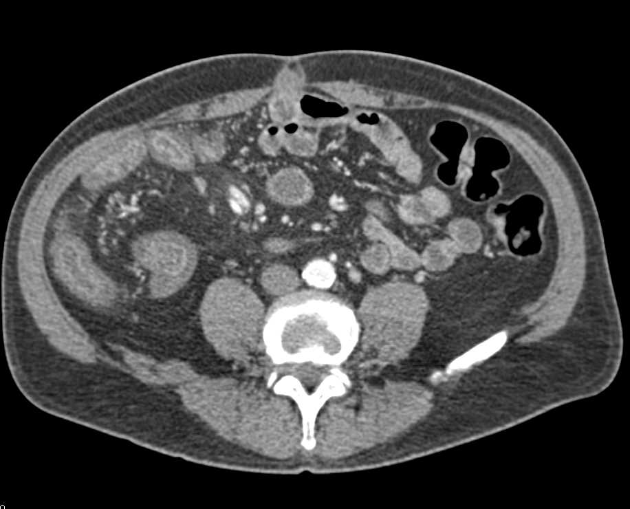 Infectious Enteritis Involving the Ileum - CTisus CT Scan