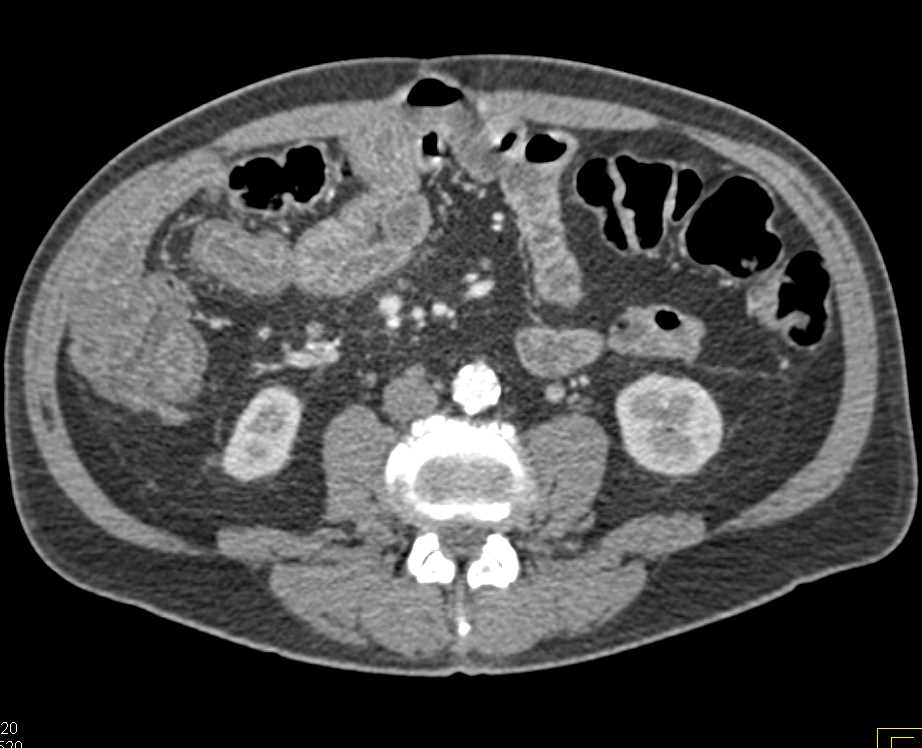 Infectious Enteritis Involving the Ileum - CTisus CT Scan