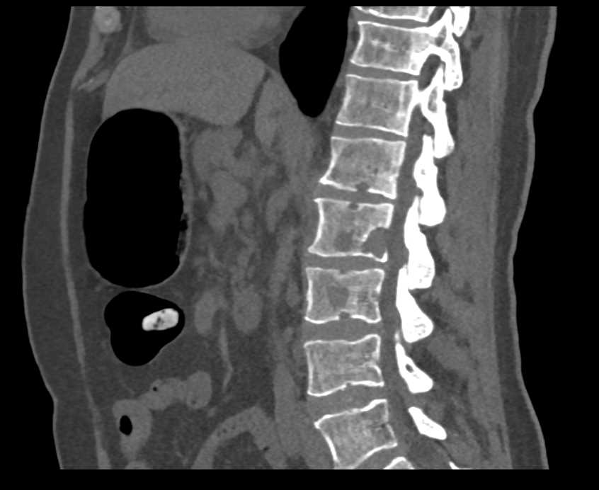 Small Bowel Obstruction (SBO) due to Incarcerated Hernia of Small Bowel in Left Lower Quadrant - CTisus CT Scan