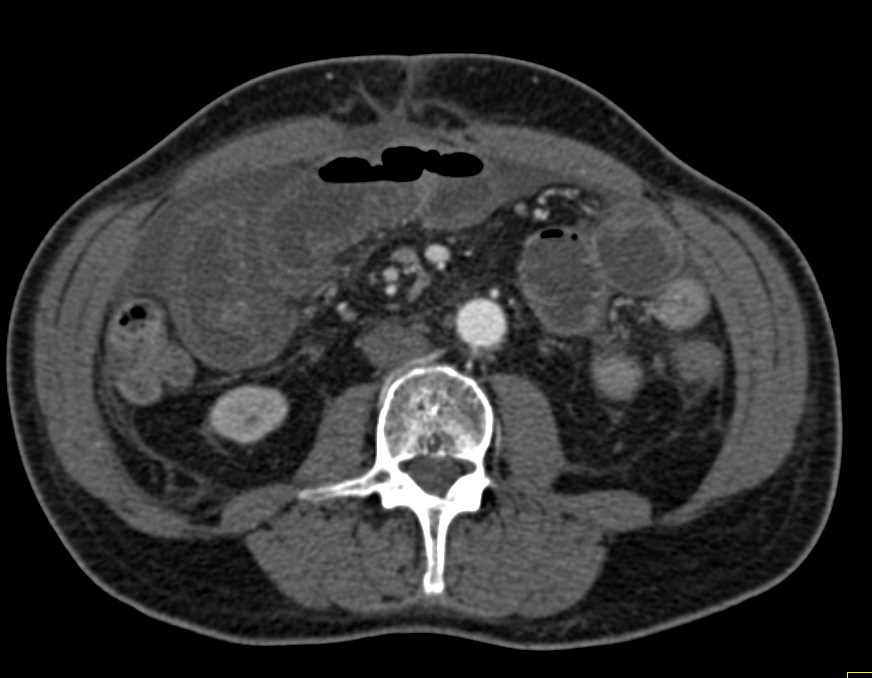 Small Bowel Enteritis - Small Bowel Case Studies - CTisus CT Scanning