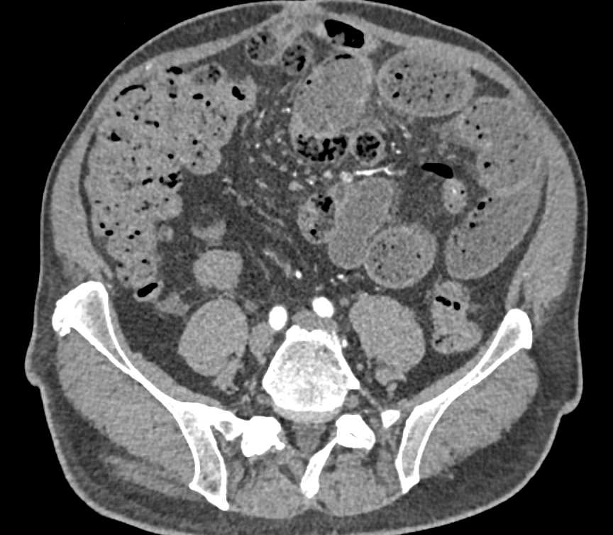 Small Bowel Obstruction (SBO) due to Adhesions - CTisus CT Scan