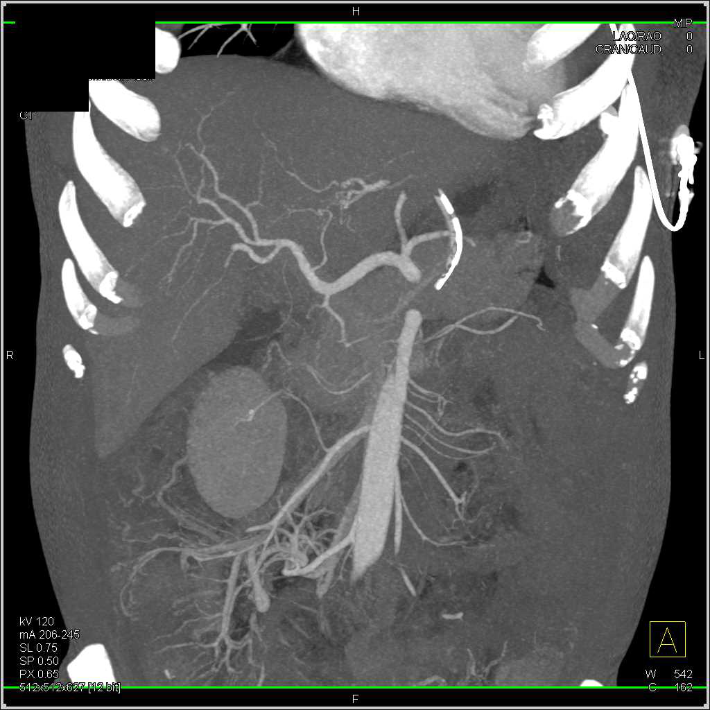 Crohn's Disease with Prominent Vasa Recta - CTisus CT Scan