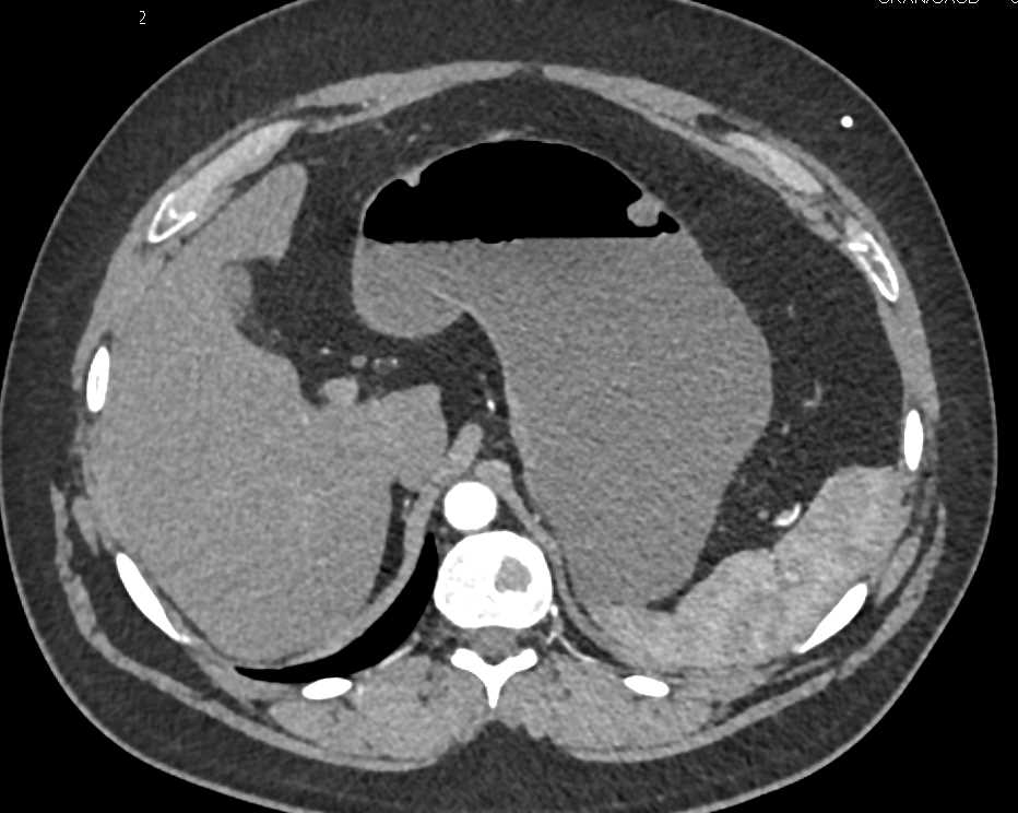 Carcinoid Tumor in Terminal Ileum. - CTisus CT Scan