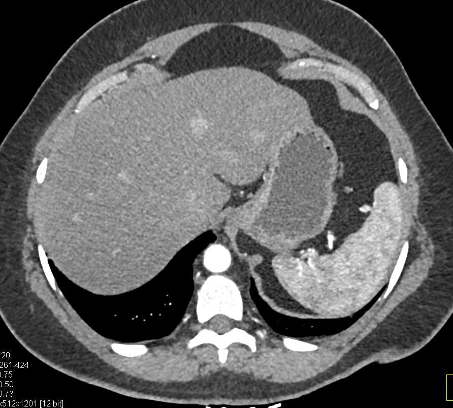 Metastatic Carcinoid Tumor to the Liver - CTisus CT Scan