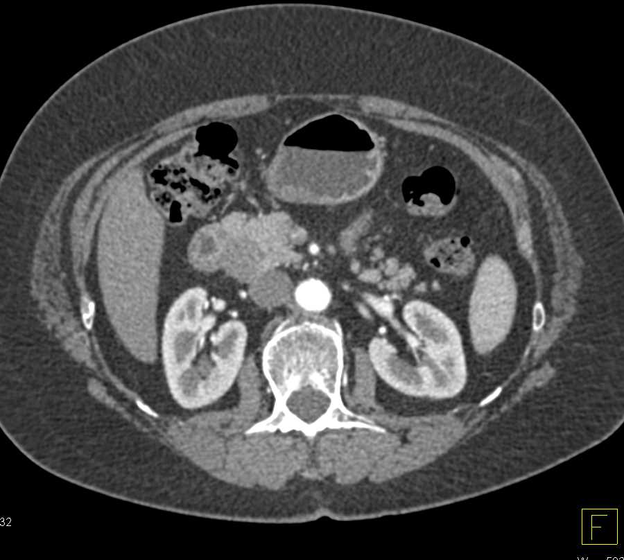 Duodenal GIST Tumor Simulates a Pancreatic Mass - CTisus CT Scan