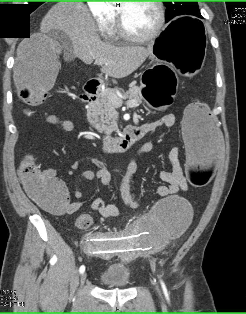 Stent in Small Bowel in Patient with Small Bowel Adenocarcinoma - CTisus CT Scan