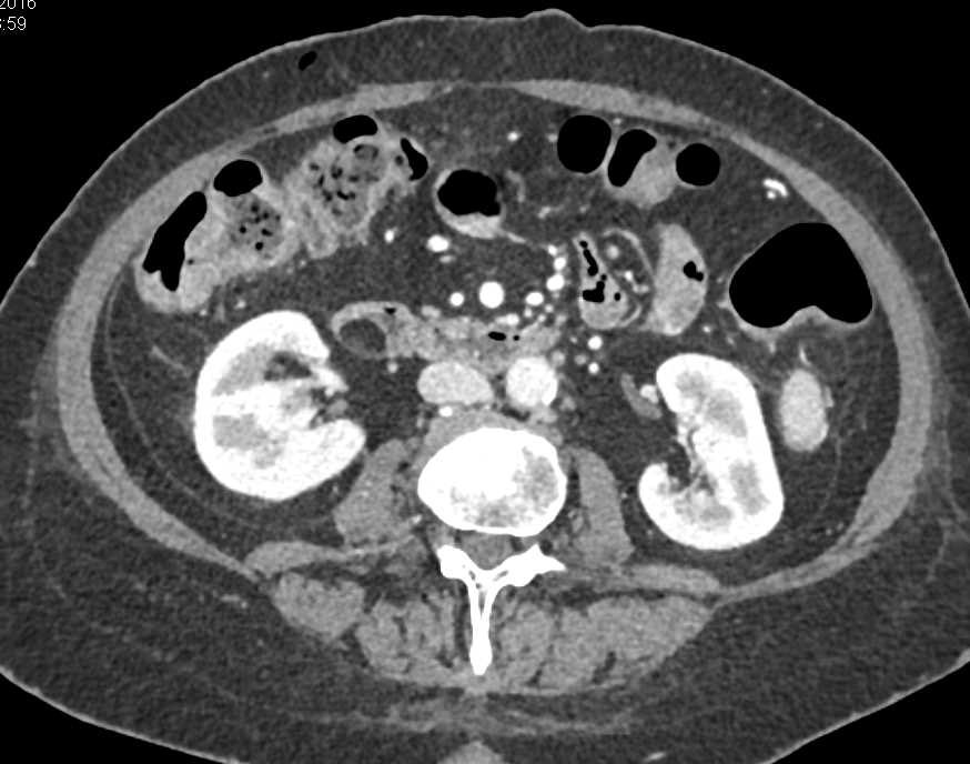 Duodenal Lipoma - CTisus CT Scan